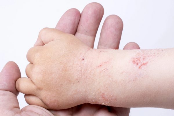 Cách chữa viêm da ở trẻ em