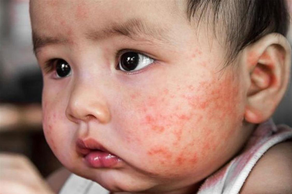 Sữa tắm cho bé bị chàm Sữa tắm cho bé bị chàm