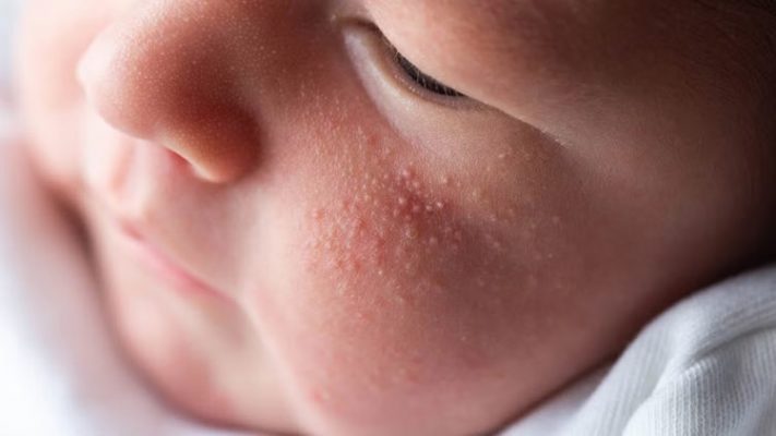 Bé bị nổi mẩn