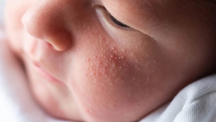Bé bị nổi mẩn