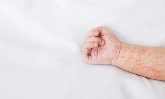 Da Bé Bị Rôm Sảy