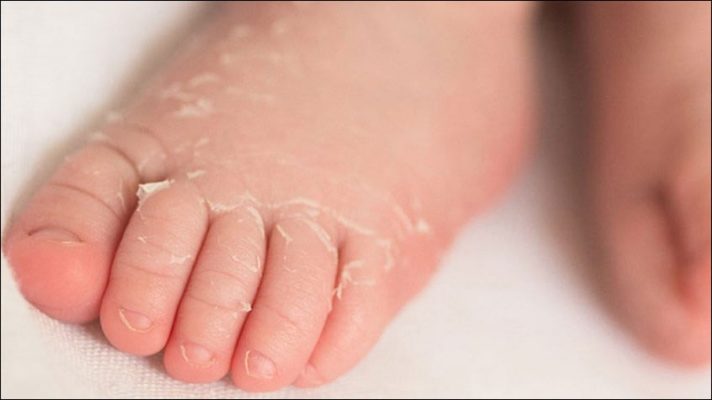 Mùa đông da bé hay khô bong tróc