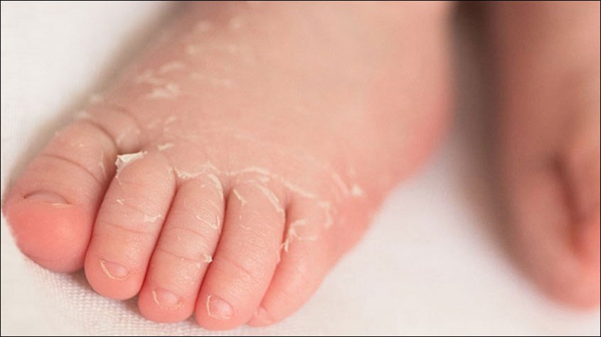 Mùa đông da bé hay khô bong tróc