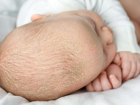 Trẻ bị cứt trâu