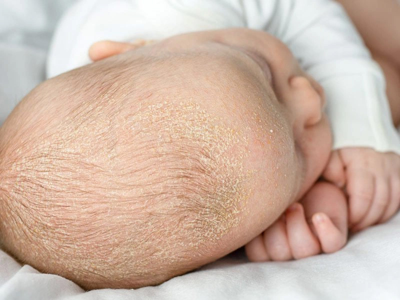 Trẻ bị cứt trâu