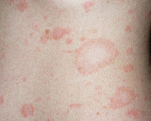 Bệnh vảy phấn trắng ở trẻ sơ sinh