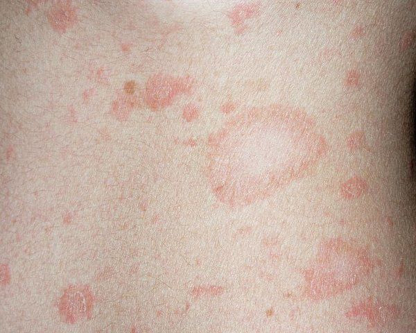 Bệnh vảy phấn trắng ở trẻ sơ sinh