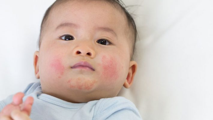 Nước tắm nào an toàn cho bé bị chàm cơ địa