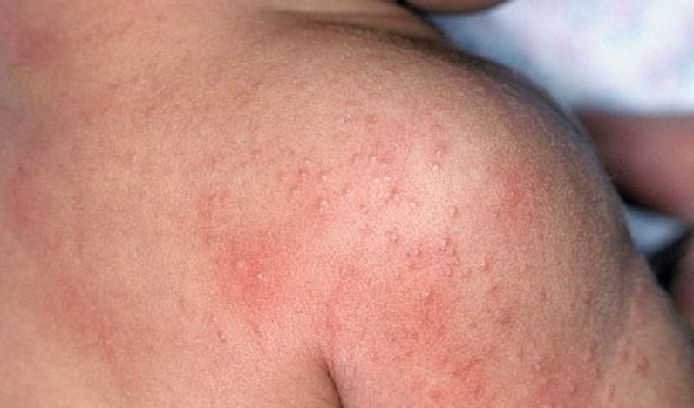 Phân biệt rôm sảy