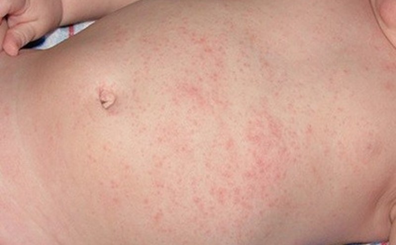 Trẻ bị rôm sảy nổi nhiều