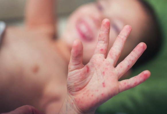 Viêm da tiếp xúc